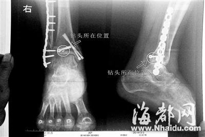 患者手术后腿里遗留钻头 院方称危害不大