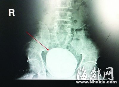 男子膀胱结石大如鸵鸟蛋 直径12cm重约7斤