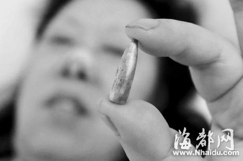 被飞来“石子”击中头 女子鼻腔存子弹47年