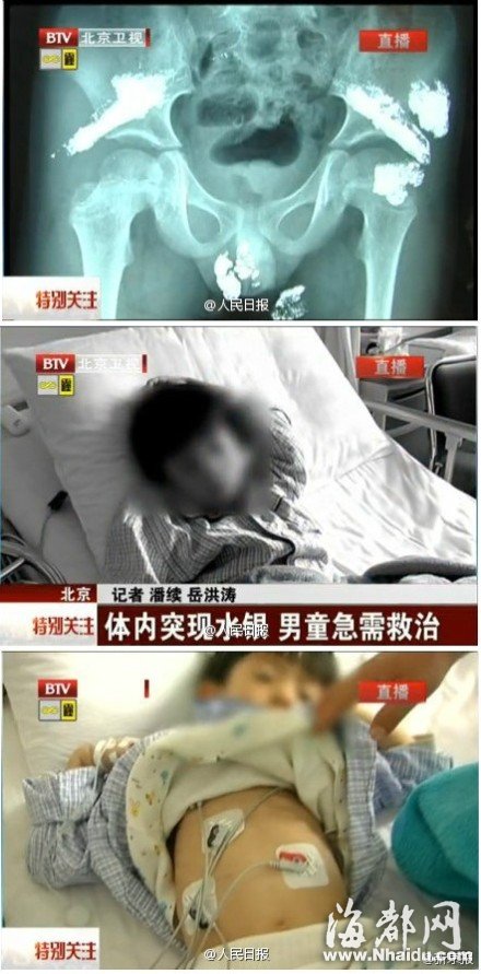 5岁男童体内疑被灌大量汞 臀部挤出水银珠