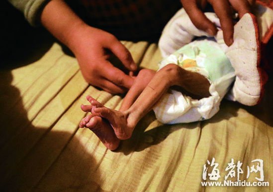男婴患先天性肛门闭锁 出生月余仅重两斤半