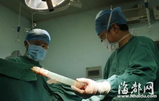 男子为寻刺激将20厘米塑料棒塞入肛门险致命