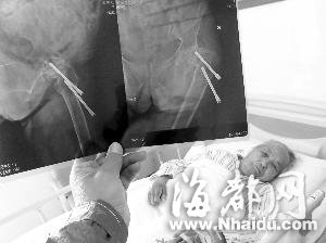 徐州102岁老人动手术 从体内取出两颗螺丝