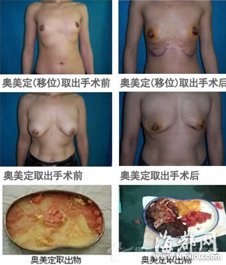成都女子丰胸11年一碰就肿 被迫“割胸”