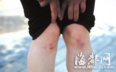 两辆电动车相撞一人受伤 路人劝就医反遭索赔