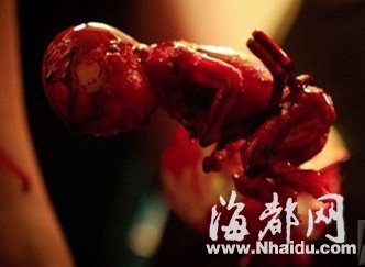 妙龄女双腿夹死胎步行至医院 鲜血染红沿途路面