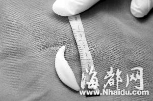 2个月大女婴胃中发现一颗5厘米长狗牙