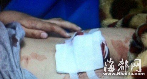 妻子怀疑丈夫有外遇 两次剪断丈夫“命根”
