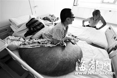 男子腰上长1.2米长“巨瘤” 重量超过200斤