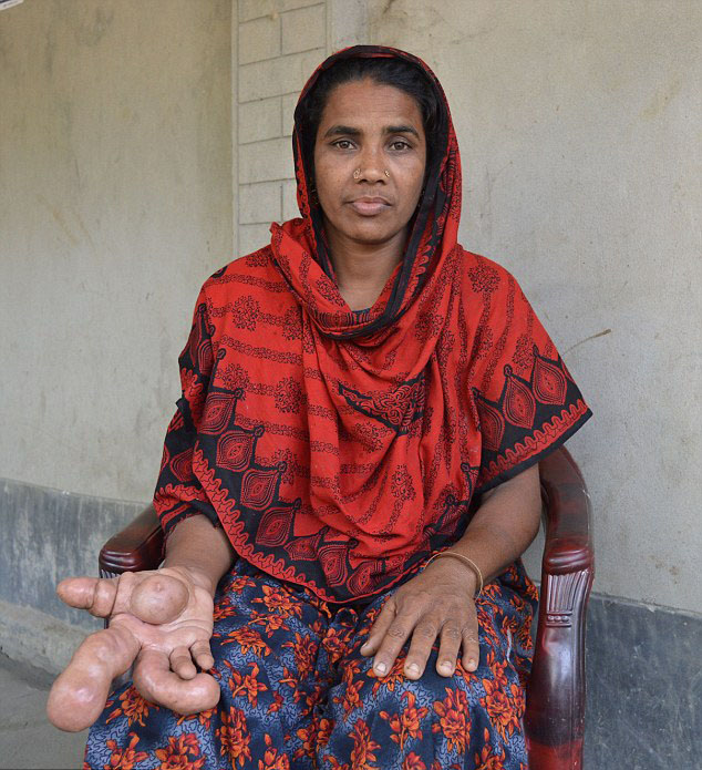 孟加拉一女子患罕见病：右手肿成足球大小 病因未明