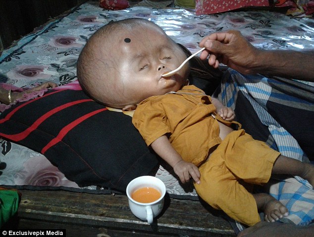 孟加拉2岁男孩患脑积水 头部重18斤相当于1岁男婴体重