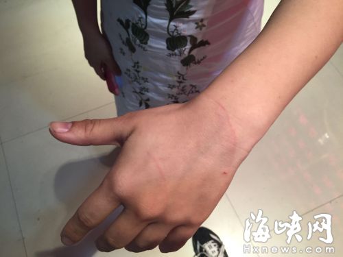林女士的手和手臂有多道抓痕(当事人供图)