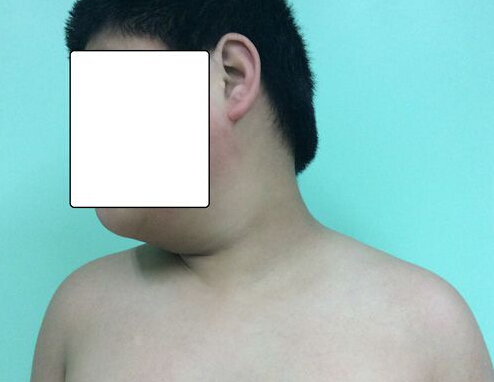 蜷缩沙发玩手机男孩“歪脖” 颈椎退化像50岁人