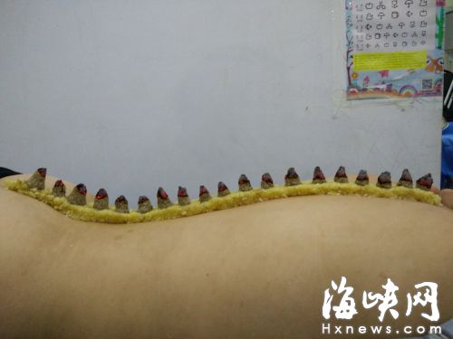 姜蒜盐“灸一灸” 孩子胃口好多了 