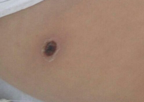 女婴被恙虫叮咬高烧险丧命 抢救半个月脱离危险