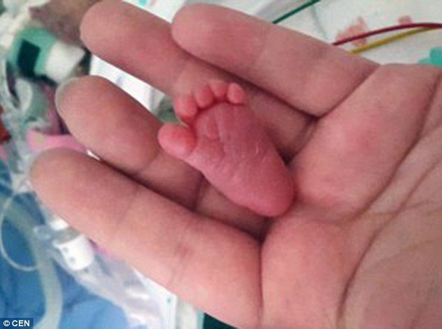 现实版拇指姑娘：世界最轻婴儿体重仅0.4斤(图)