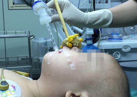 不小心摔倒：1岁娃筷子捅鼻 7岁娃铅笔插脸