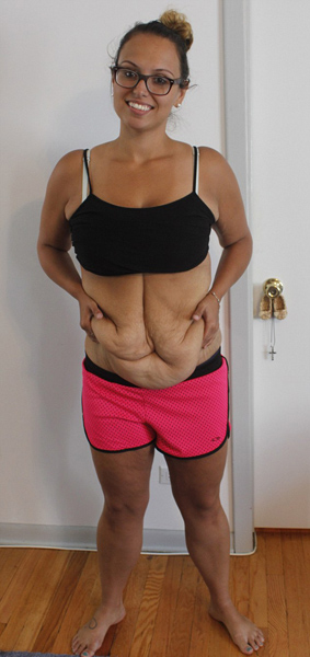 美国妇女一年减重117斤 望众筹去除多余松弛皮肤
