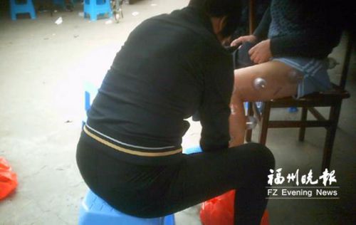 女子菜市场内摆摊针灸拔罐 消毒方式令人担忧