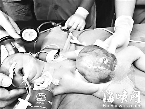 肚皮上有个“窟窿” 男婴内脏裸露在外