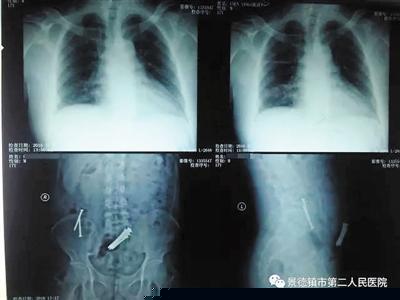 景德镇第二医院拍摄的X光片显示，査澄华腹中有9枚钢钉