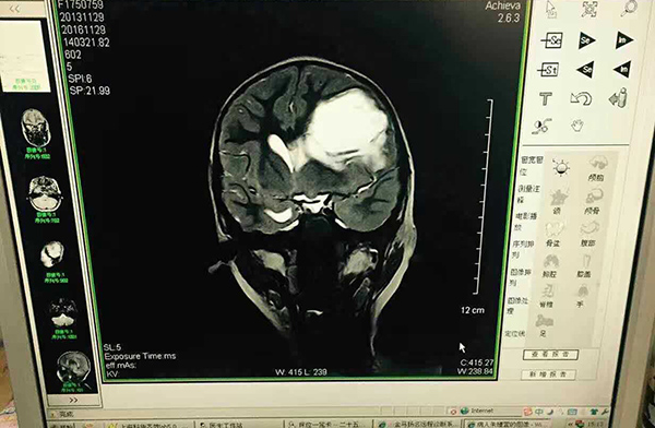 萱萱的脑部X光片