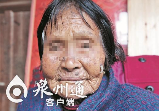 82岁老太脸上长“羊角” 医生：是皮角