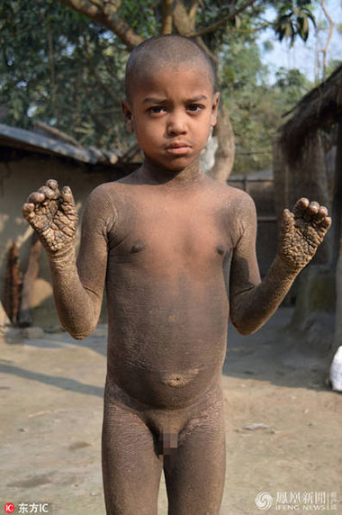 孟加拉小男孩Mehendi Hassan患有罕见皮肤病成石头人【图】