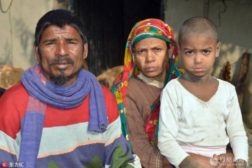 孟加拉小男孩Mehendi Hassan患有罕见皮肤病成石头人【图】