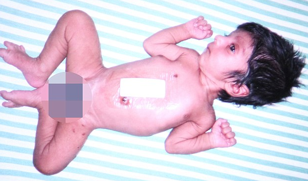 印度男婴患多肢畸形 一生下来就有四条腿被称“上帝的礼物”（2）