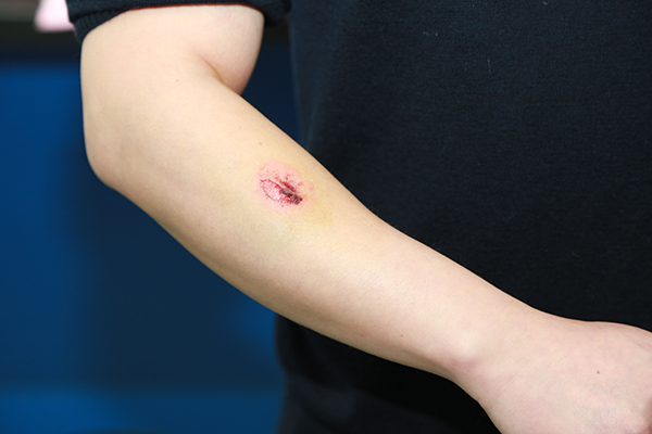 民警苏金辉右手前臂被咬伤出血。