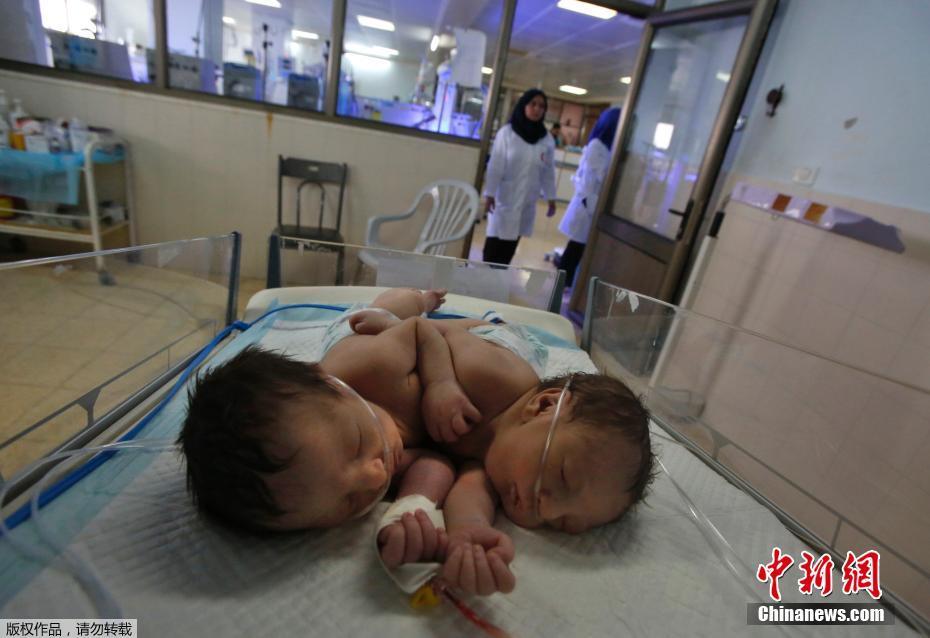 巴勒斯坦一医院连体婴儿出生 姐妹俩面对面 为什么会有连体婴儿？