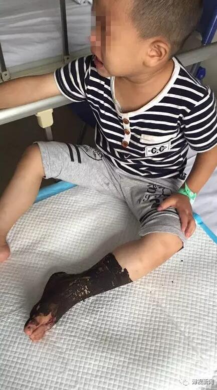 漳州一3岁男童出去串门 被一条竹叶青蛇咬伤左脚