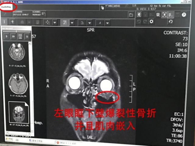 冉莹颖称邹市明眼疾将做手术 病情确诊光片首公开