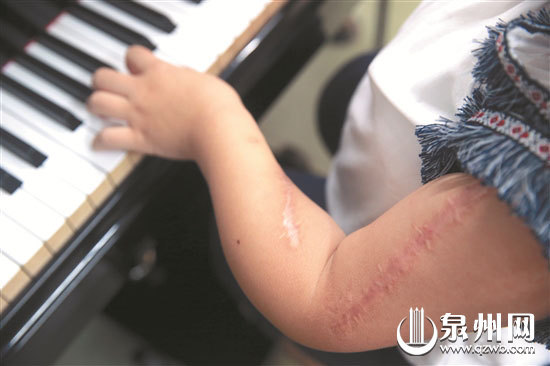 十次大手术上百次骨折 “瓷娃娃”钢琴声乐均过十级