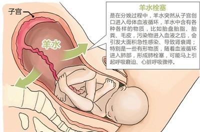 刘强东妹妹42岁生三胎去世，夺走她的是产科死亡率排第一的疾病
