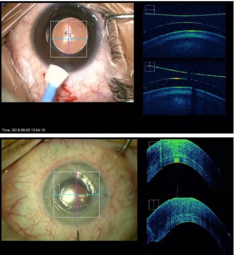 全国首台oct术中显微镜落户厦门眼科中心 助力眼科手术更安全1764