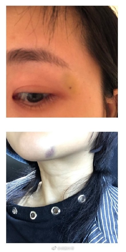 张嫮目疑家暴是真的吗？张嫮目是谁个人资料女友张珂玄曝被家暴证据