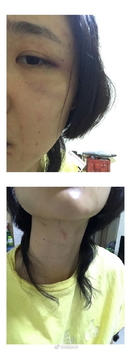 张嫮目疑家暴是真的吗？张嫮目是谁个人资料女友张珂玄曝被家暴证据