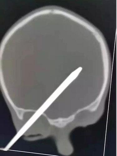 医生拔大脑钢针是怎么回事？钢针为什么会插进2岁孩子的大脑里的